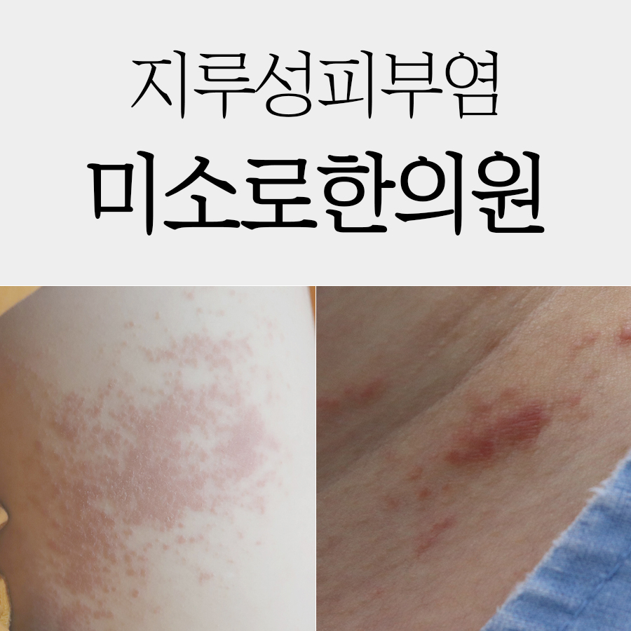 위례 지루성피부염 원인 및 치료법 관련 이미지 1