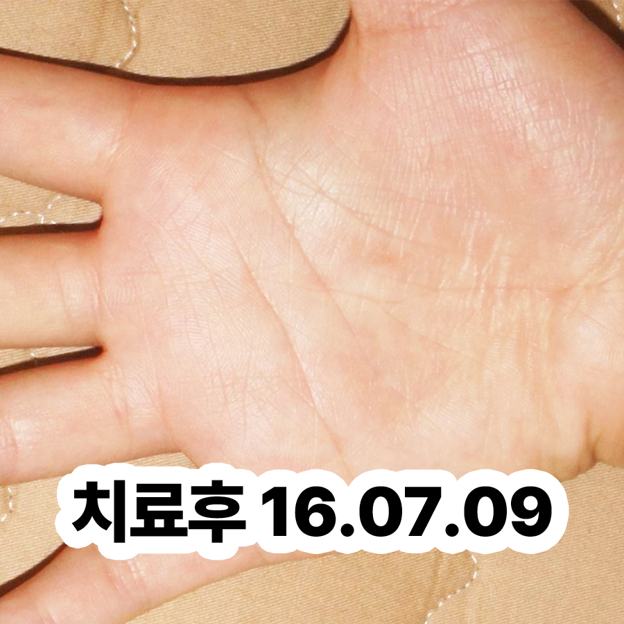 분당 한포진 피부과 추천 관련 이미지 3
