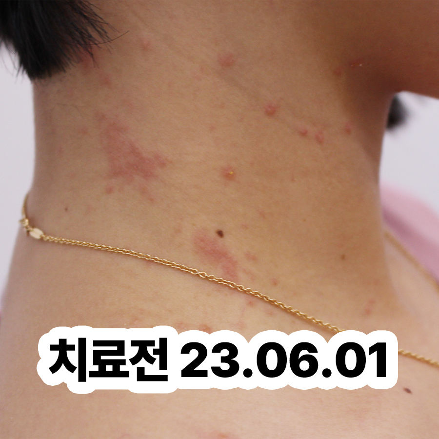 여주 고환 습진 병원 관련 이미지 2