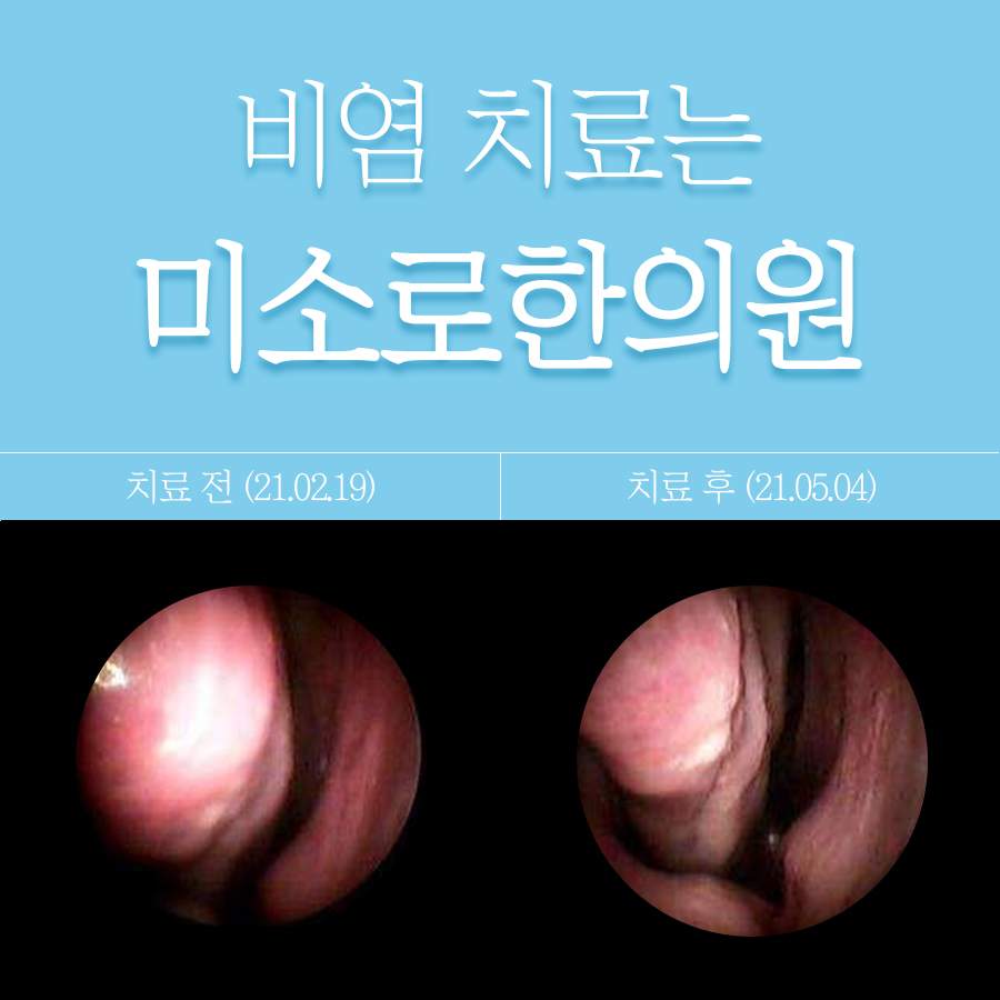 이천 비염치료비용 관련 이미지 1