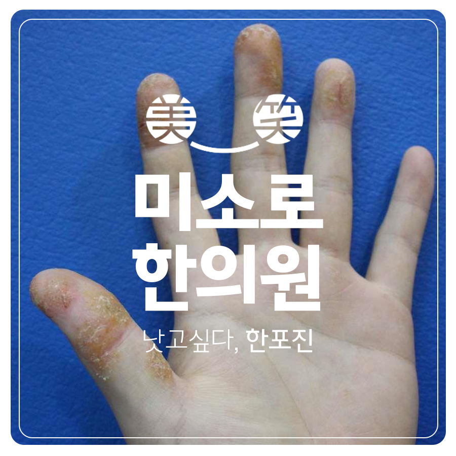 분당 발 한포진 연고 관련 이미지 1