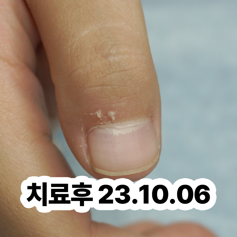 판교 발바닥사마귀치료 후 통증 관련 이미지 3
