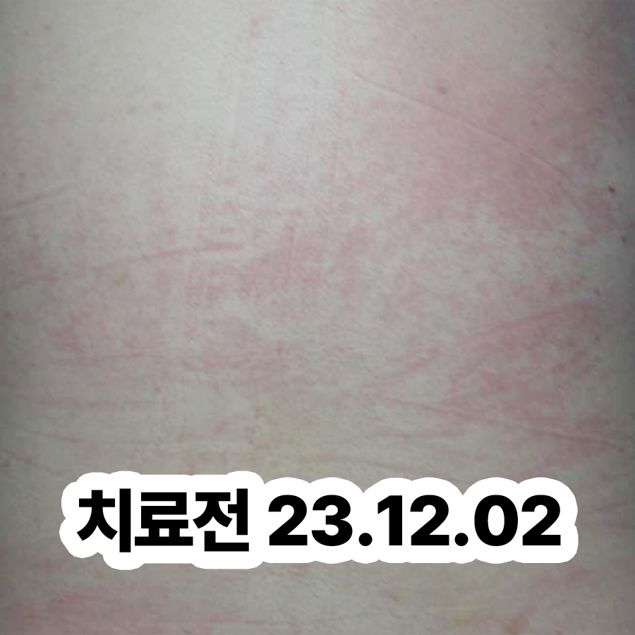 위례 피부묘기증 한의원 관련 이미지 2