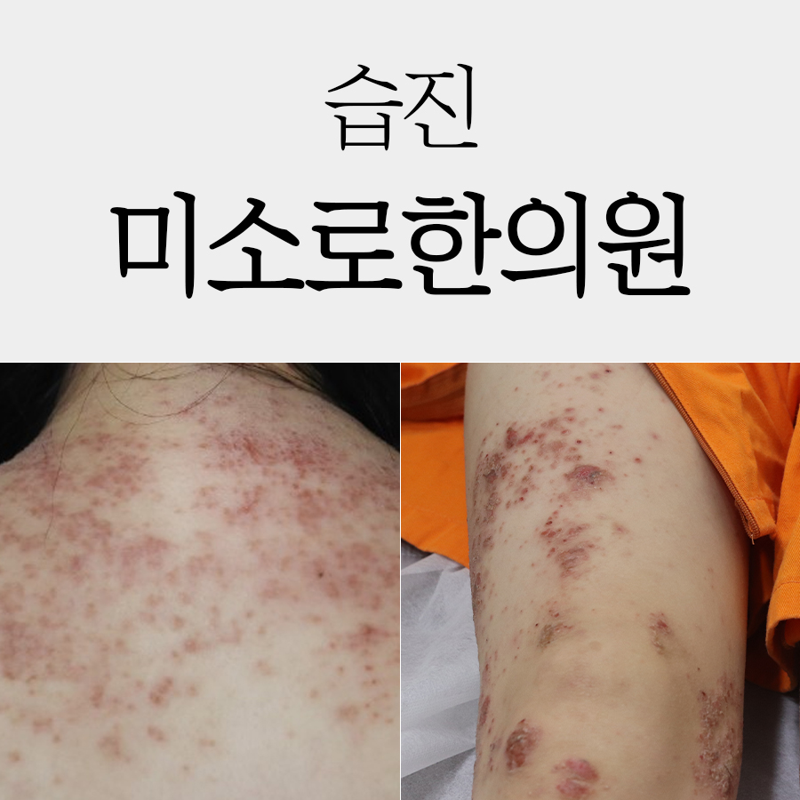 용인 화폐상습진 원인 관련 이미지 1