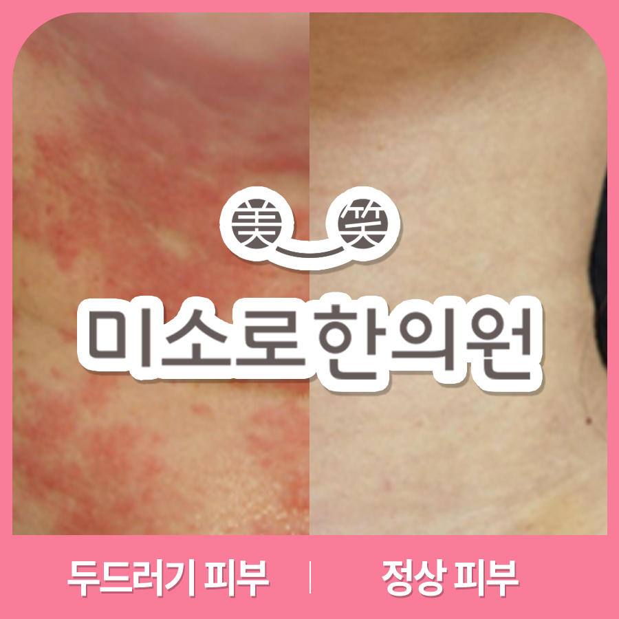 분당 알레르기 두드러기 병원 어디로 관련 이미지 1