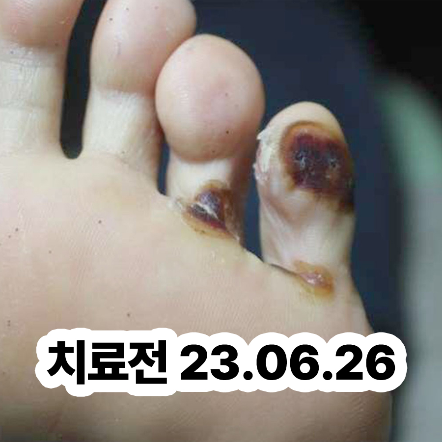 분당 편평사마귀 한약 비용 관련 이미지 2