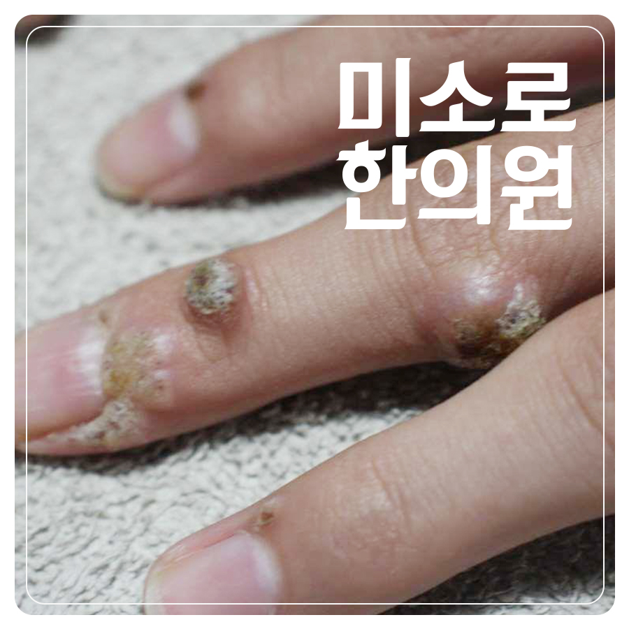 분당 편평사마귀 병원 성지 관련 이미지 1