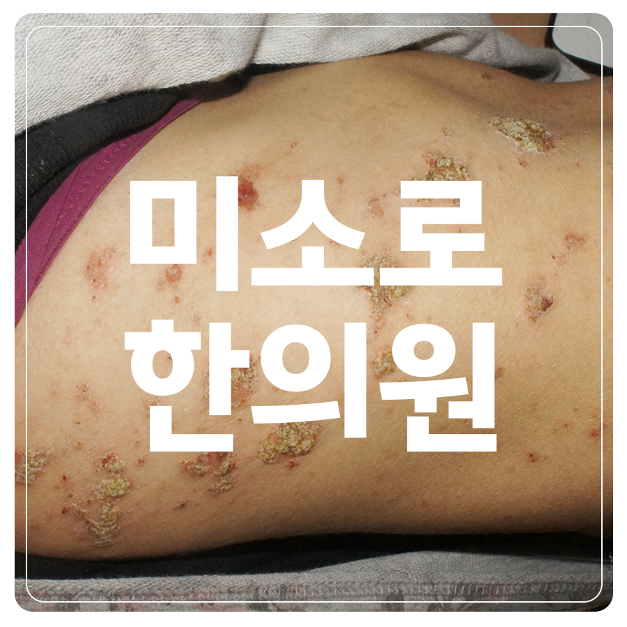 분당 화폐상 습진 치료 방법 관련 이미지 1