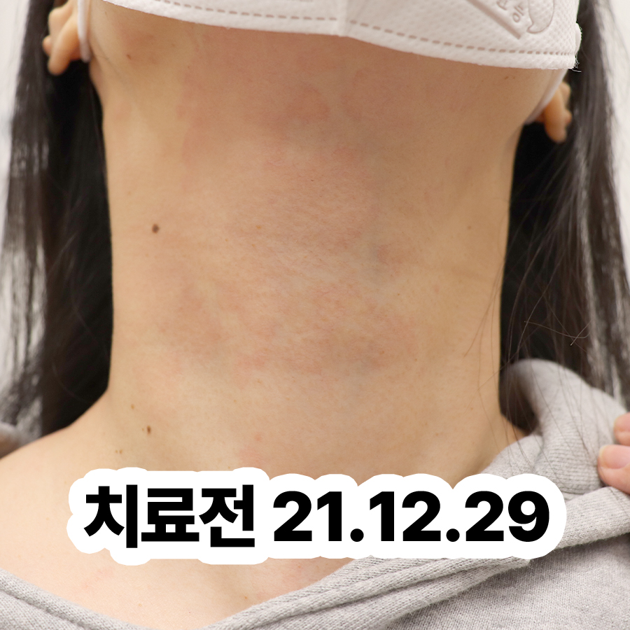 성남 피부묘기증 관련 이미지 2