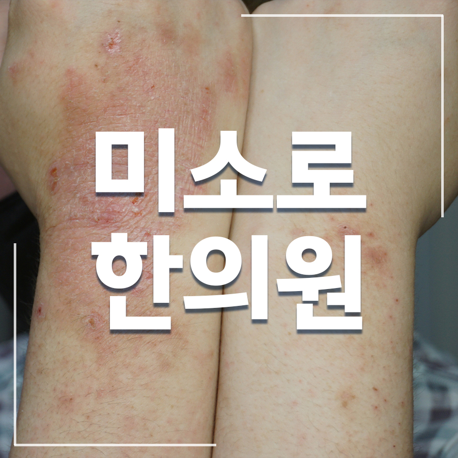 안산 아토피에 좋은 약초 관련 이미지 1