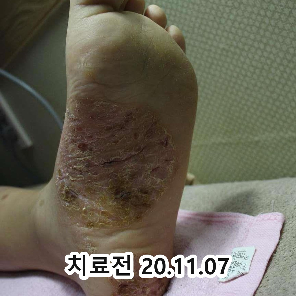 판교 사타구니 습진 병원 어디로 관련 이미지 2