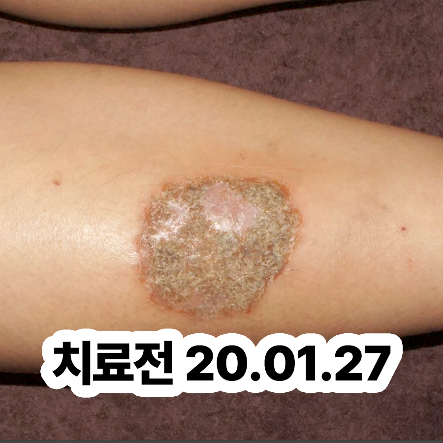 경기광주 만성 주부습진 치료 관련 이미지 2