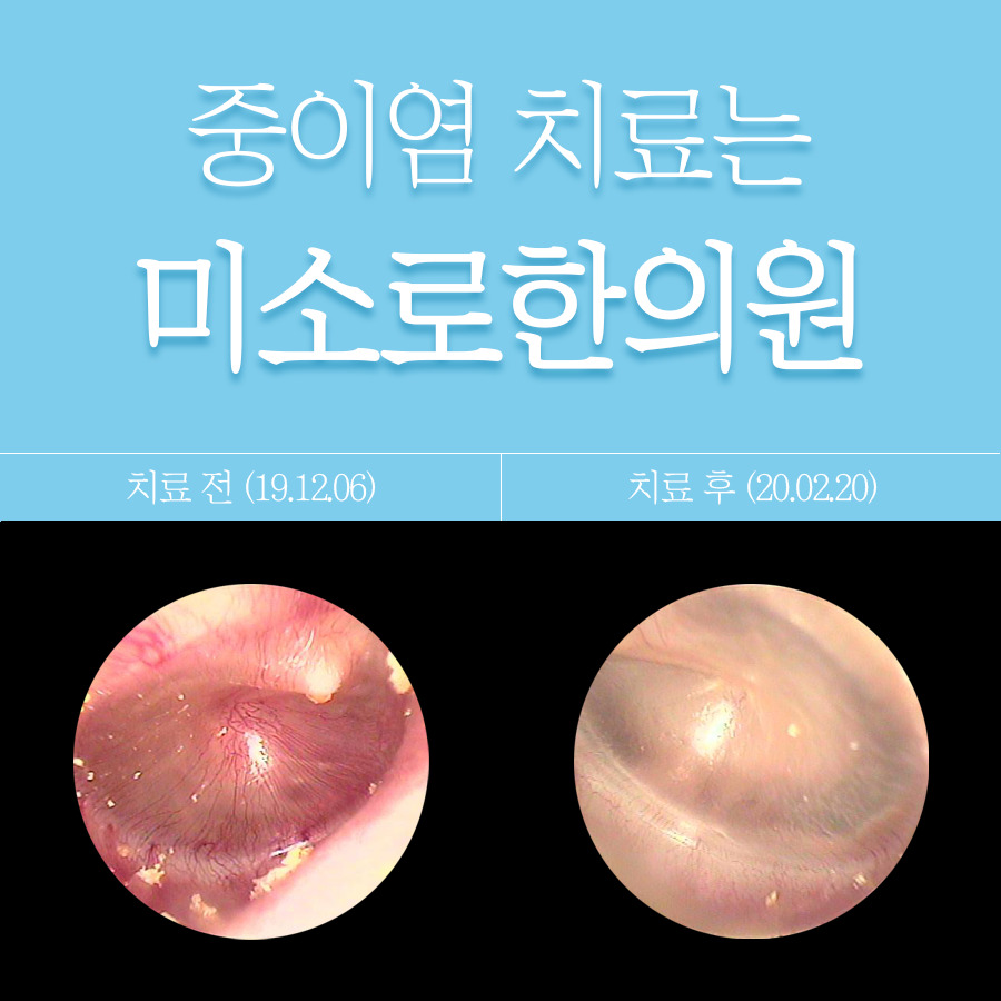 분당 삼출성 중이염 완치 관련 이미지 1