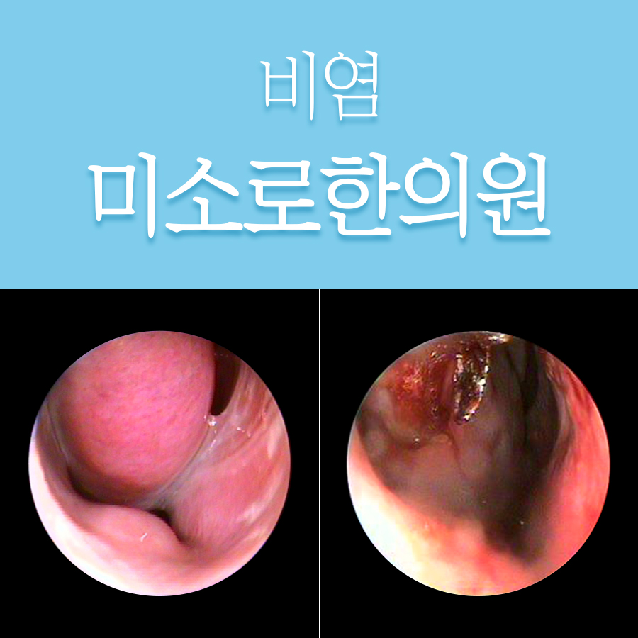분당 소아알레르기비염 관련 이미지 1