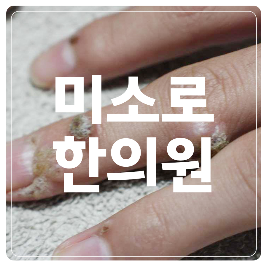 안산 한의원 사마귀치료 관련 이미지 1