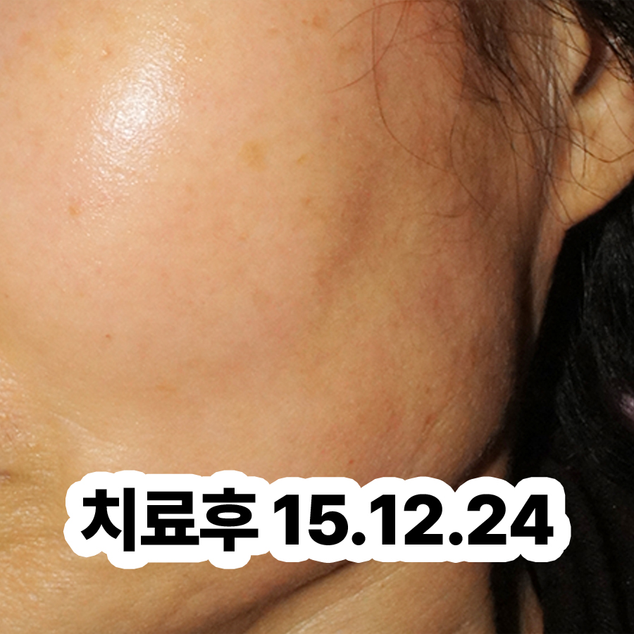 분당 지루성피부염 한의원 관련 이미지 3