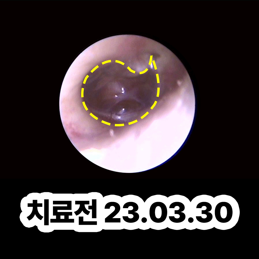 여주 만성중이염 수술방법 관련 이미지 2