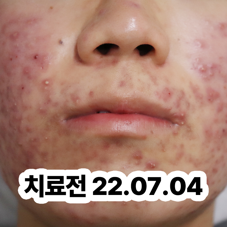 이천 얼굴 지루성 피부염 원인 관련 이미지 2