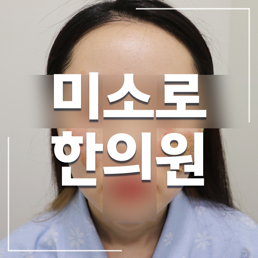 중동 화폐상 습진 치료 방법
