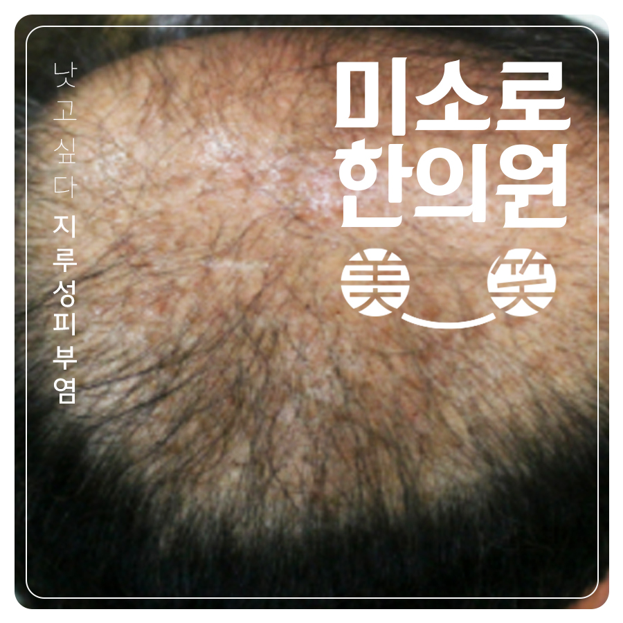 수내동 지루성 피부염 피부과 시술