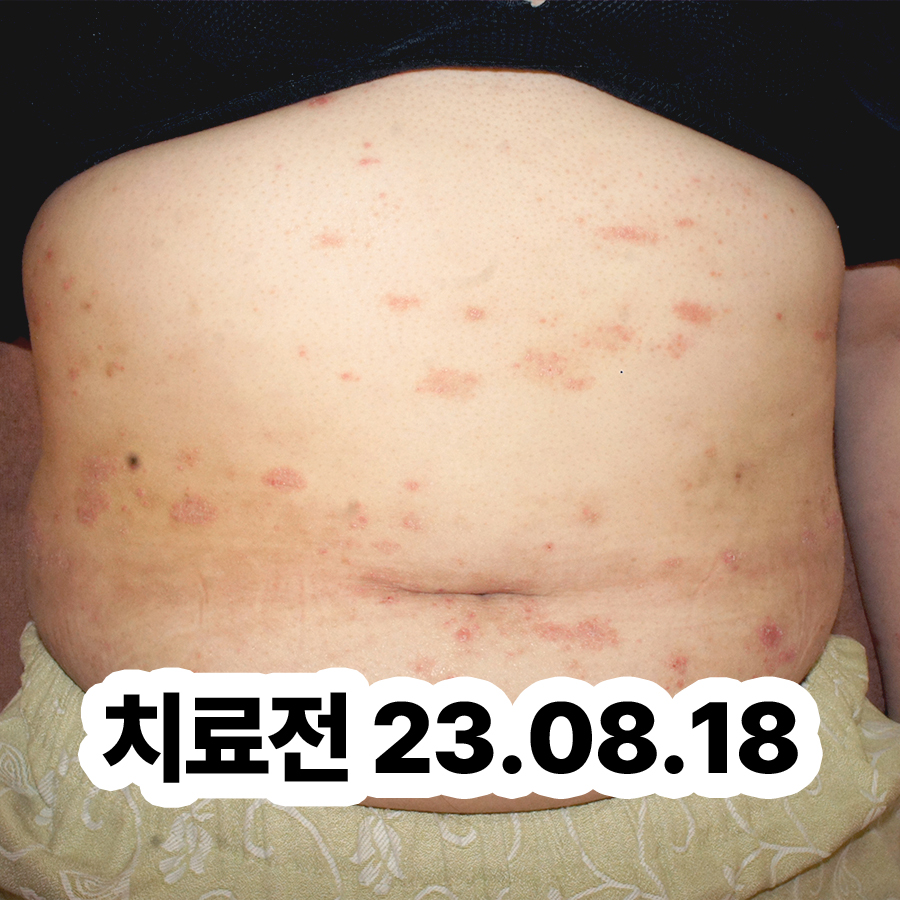 분당 건선피부치료 관련 이미지 2