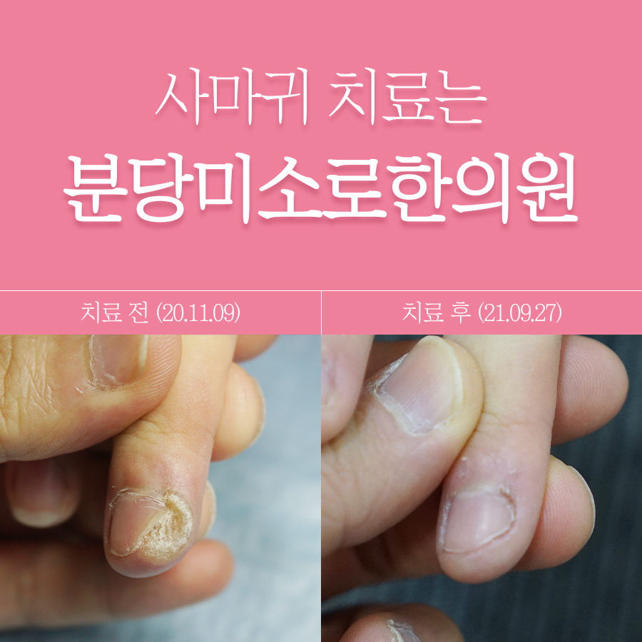 경기광주 발바닥 사마귀 치료법 관련 이미지 1