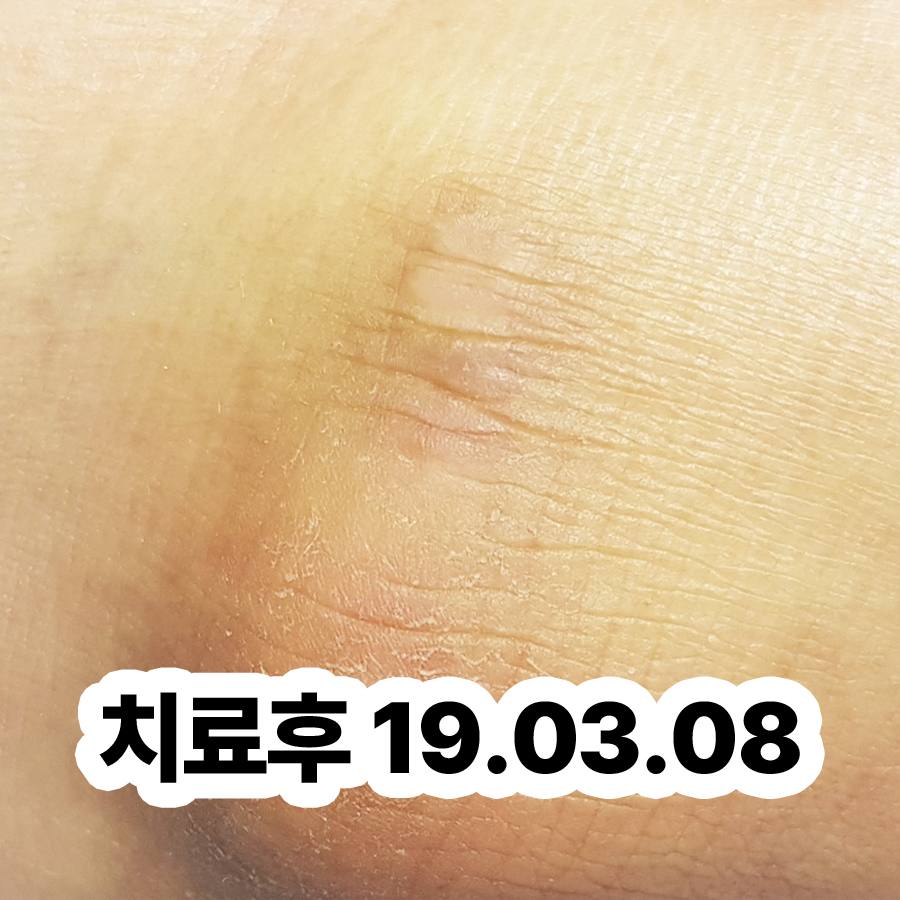 분당 사마귀 병원 관련 이미지 3