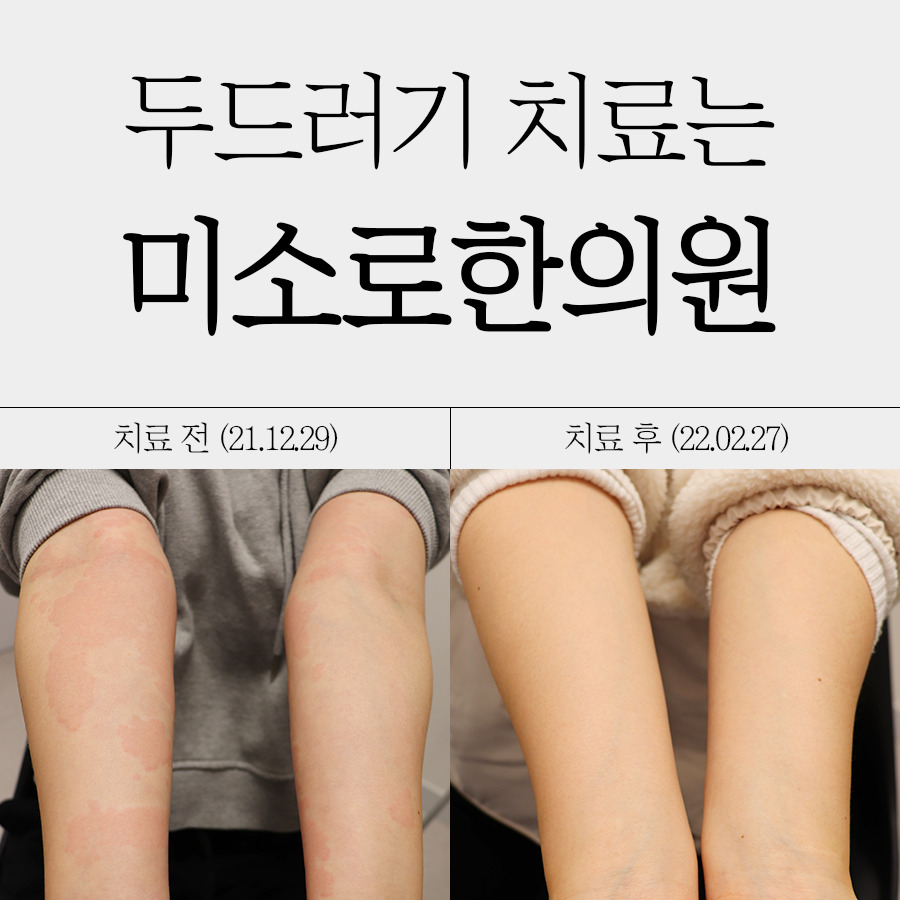 분당 만성두드러기 한의원 치료 관련 이미지 1
