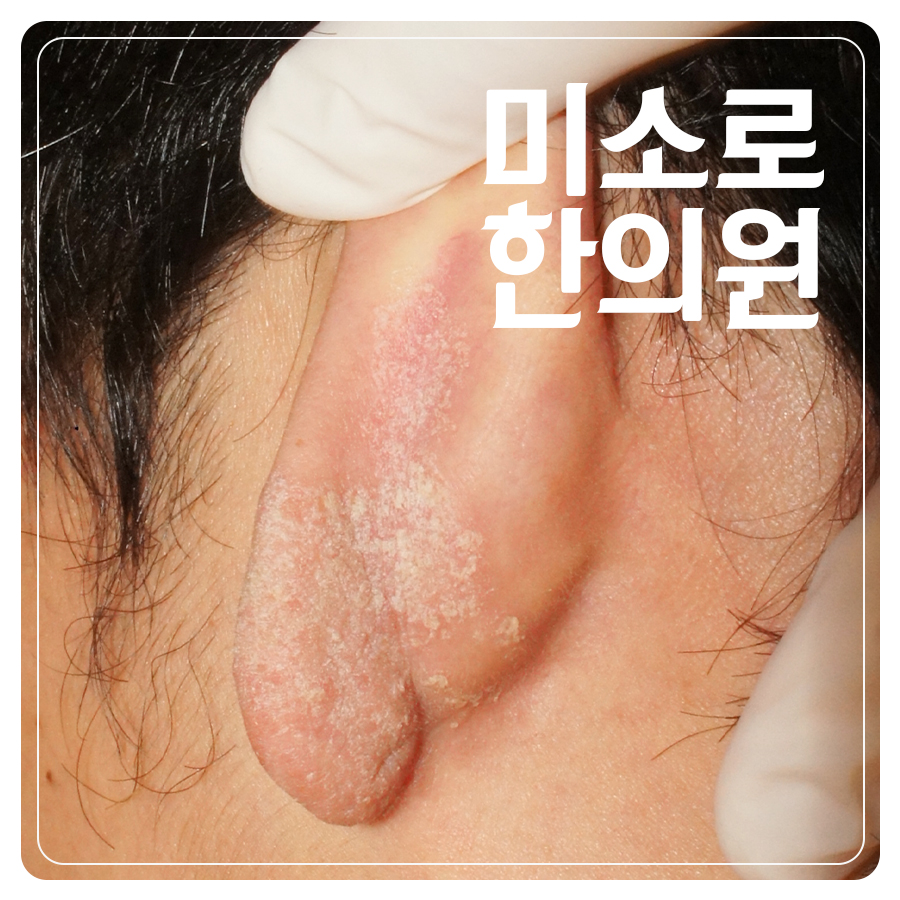 분당 농포성 건선 관리 관련 이미지 1