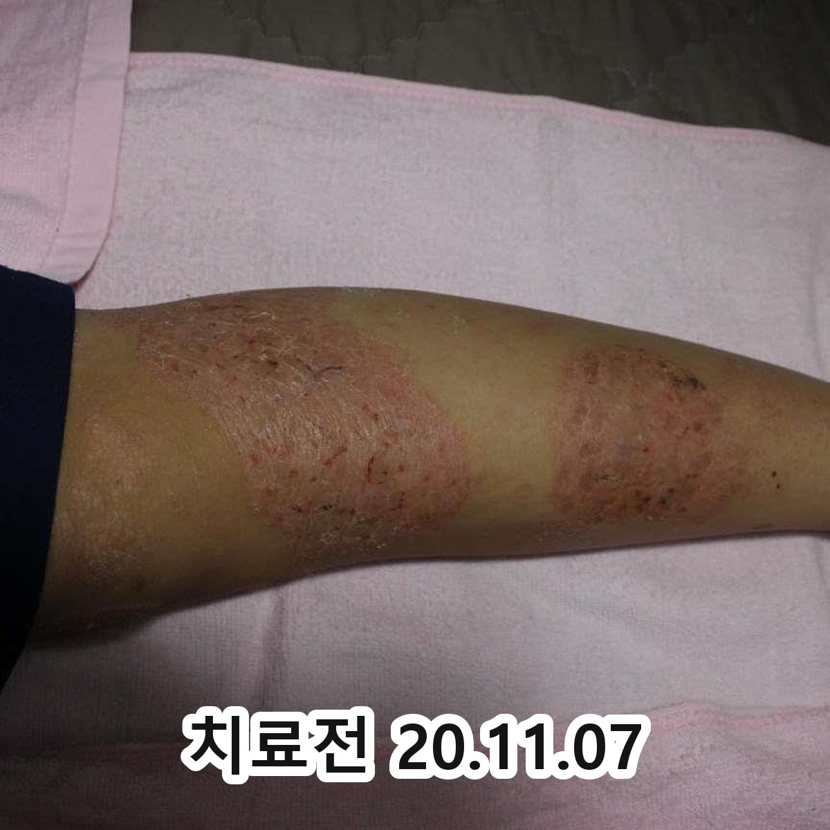성남 화폐상습진 연고 관련 이미지 2