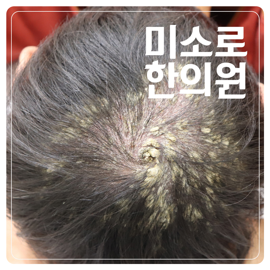 용인 건선 보습제 추천 관련 이미지 1