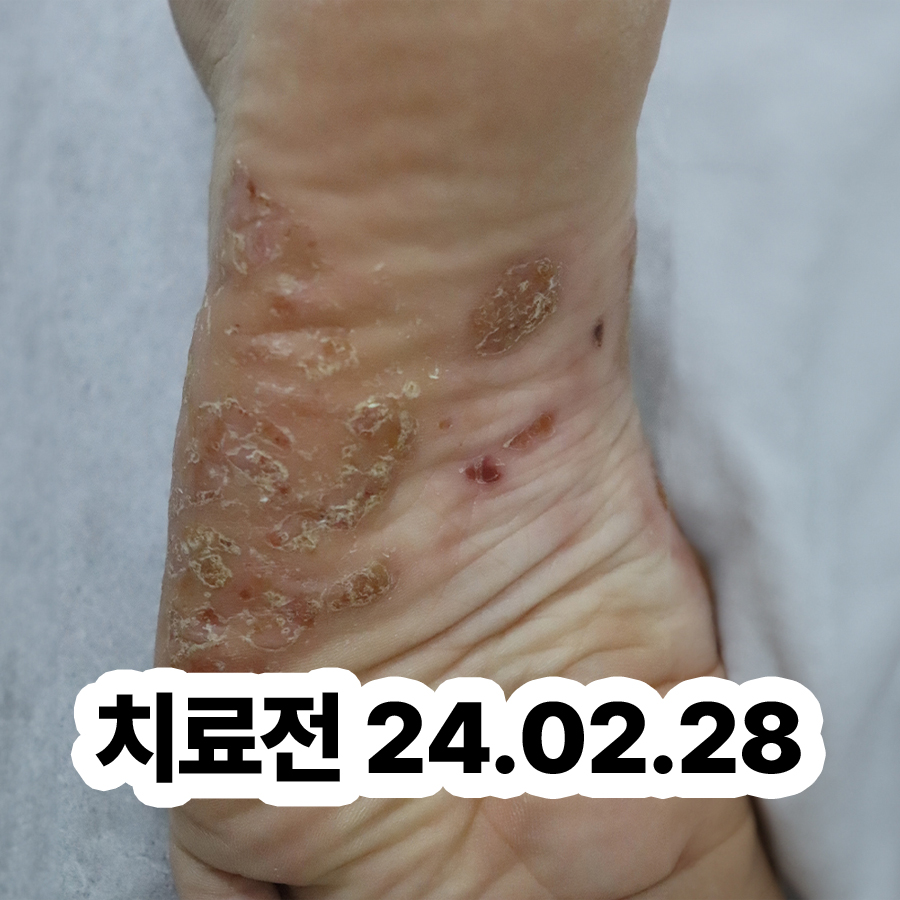성남 한포진 치료법 관련 이미지 2