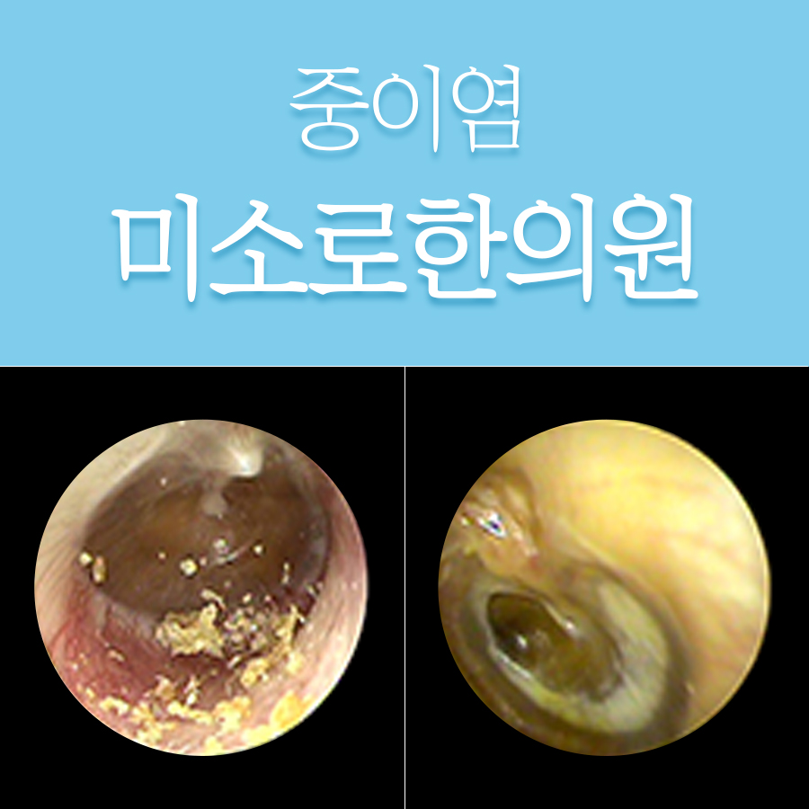 용인 삼출성 중이염 한의원 관련 이미지 1