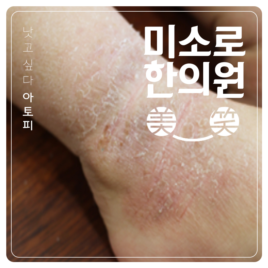 판교 다리 아토피 치료 방법 관련 이미지 1