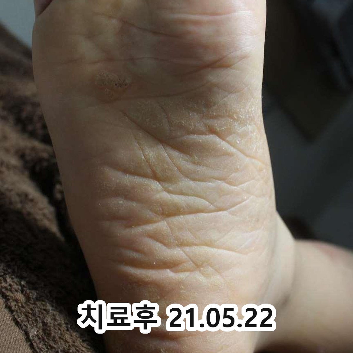 봉동 화폐상습진 연고 관련 이미지 3