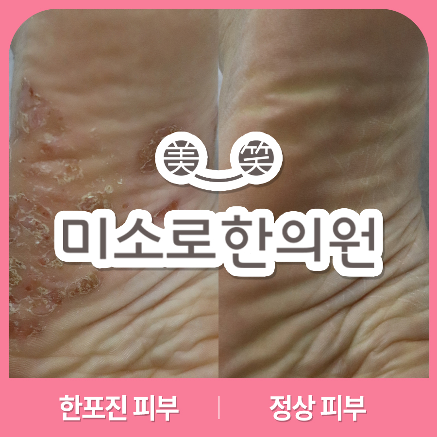 여주 한포진 병원 어디로 관련 이미지 1