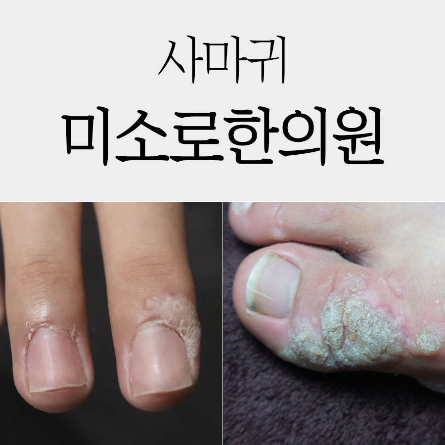 분당 사마귀 병원 관련 이미지 1