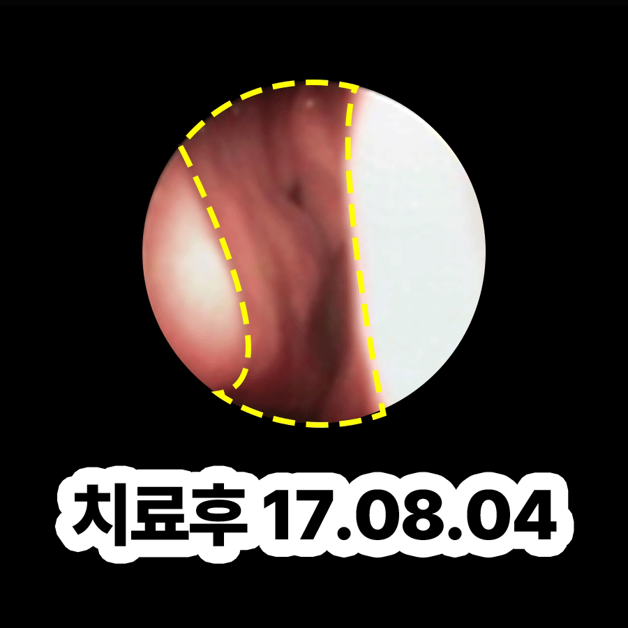 성남 곰팡이균 축농증 증세 관련 이미지 3