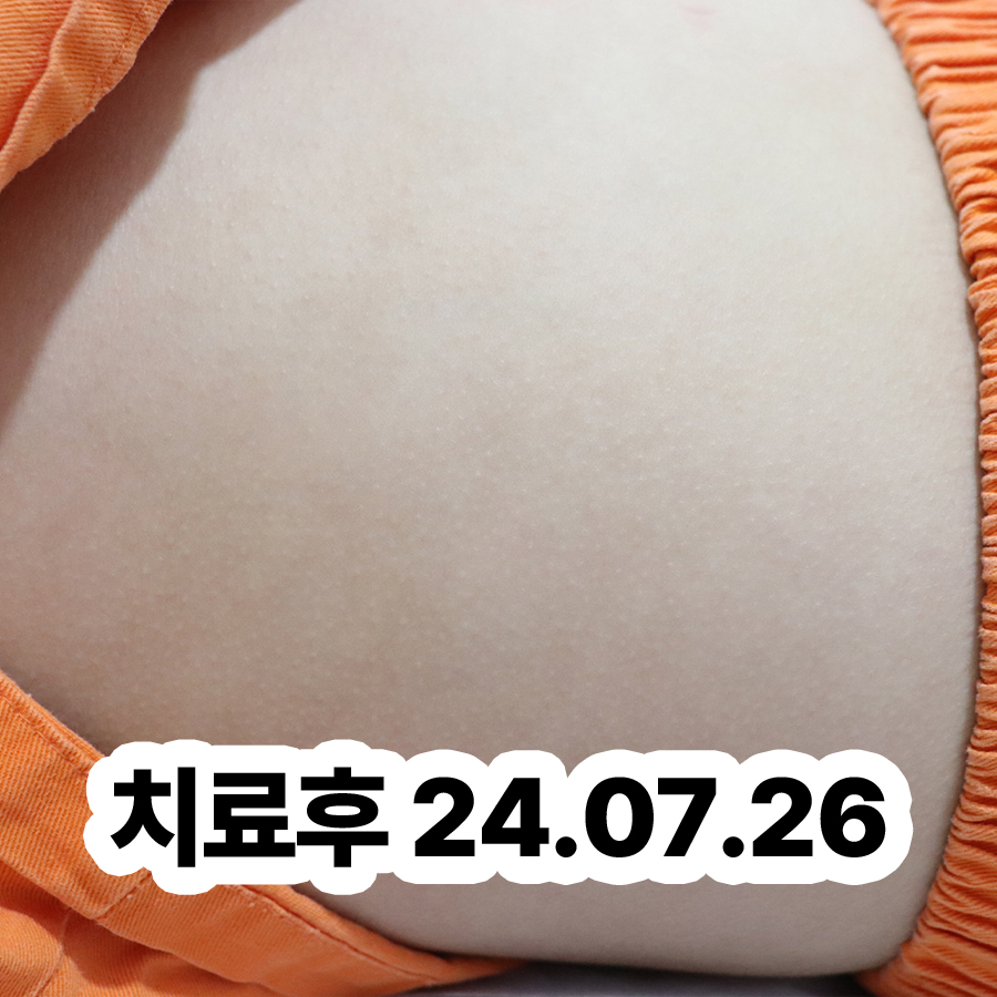 경기광주 얼굴 지루성 피부염 치료 관련 이미지 3