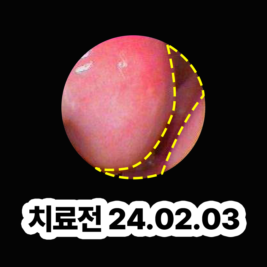 판교 알레르기 비염 치료 비용 관련 이미지 2