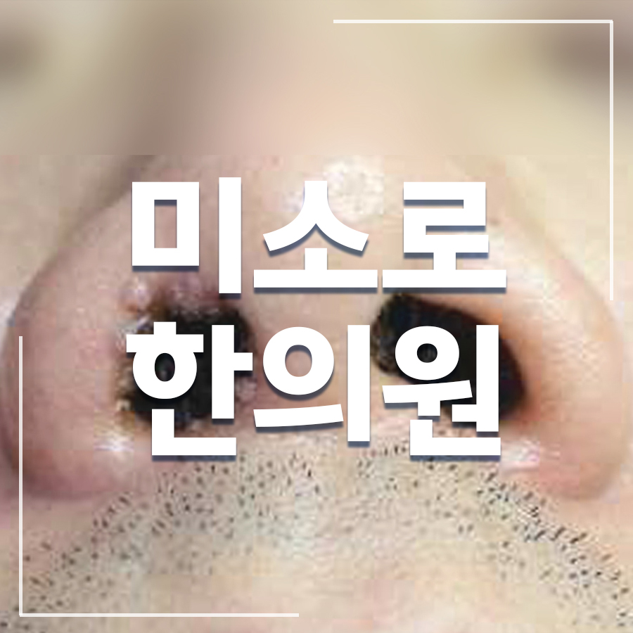 성남 편평사마귀제거레이저 관련 이미지 1
