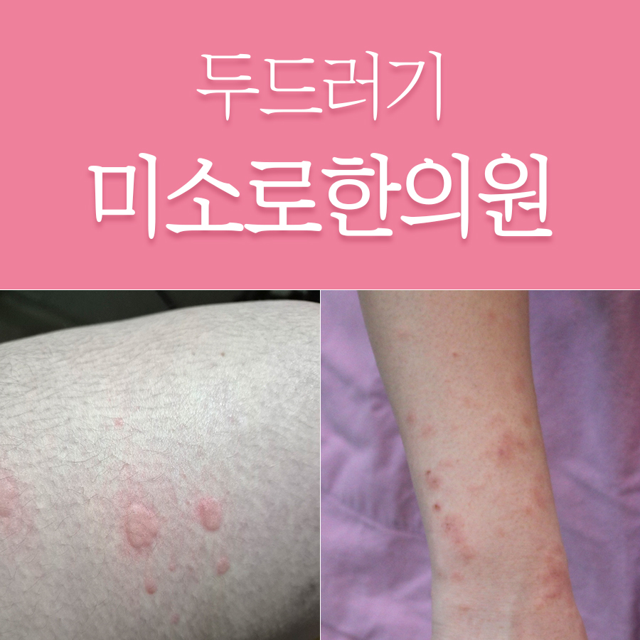 이천 콜린성 두드러기 한의원비용 관련 이미지 1