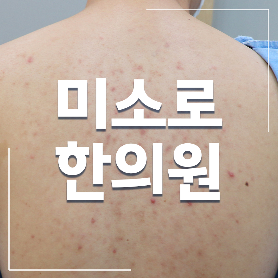 본오동 콜린성 두드러기 치료법 관련 이미지 1