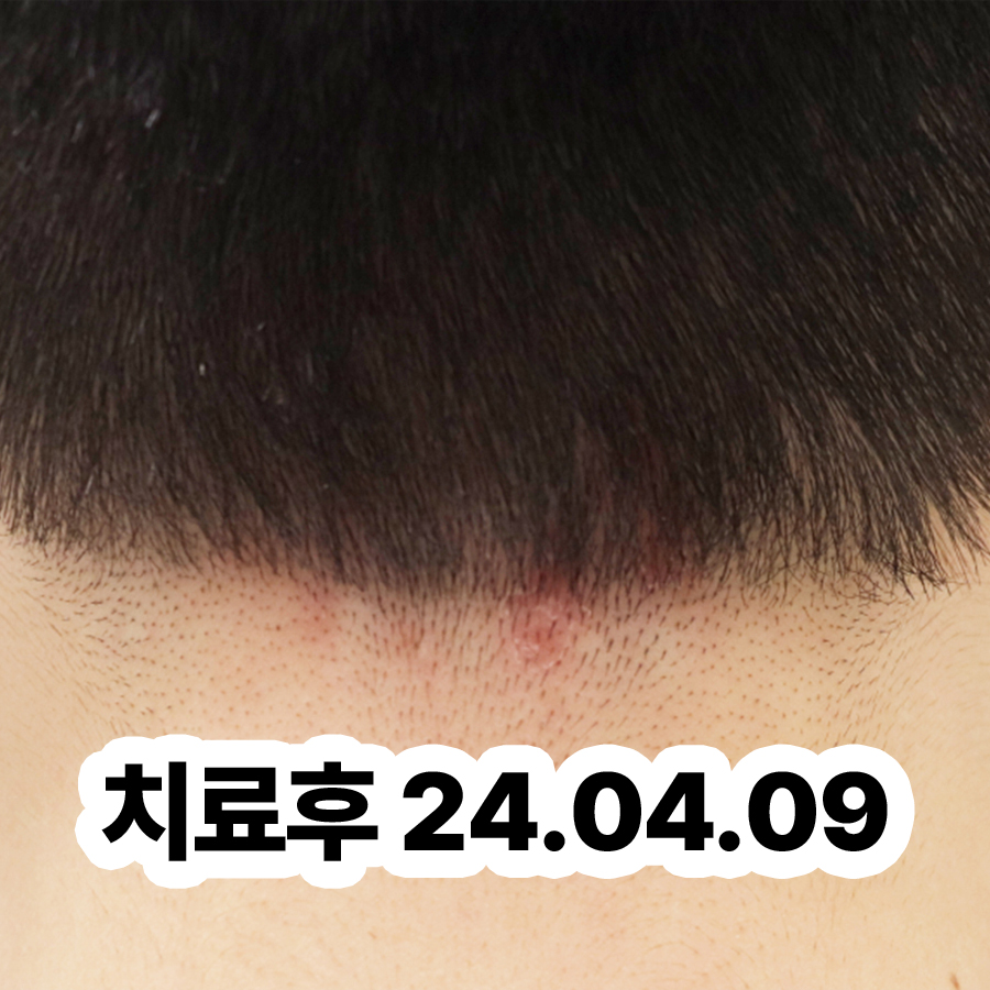 분당 지루성피부염한의원추천 관련 이미지 3