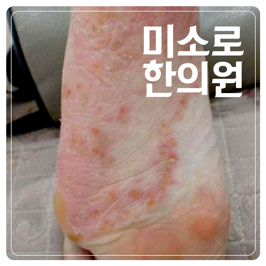 이천 발바닥 한포진 연고 추천 관련 이미지 1