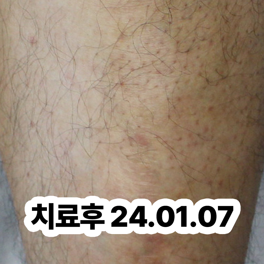 판교 피부 건선 치료법 관련 이미지 3