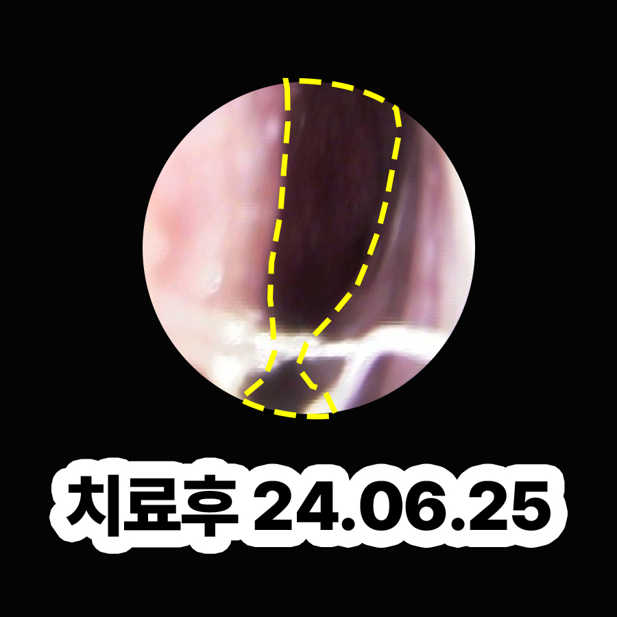 분당 비염치료잘하는병원 관련 이미지 3