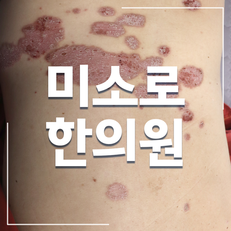 판교 건선치료법 관련 이미지 1