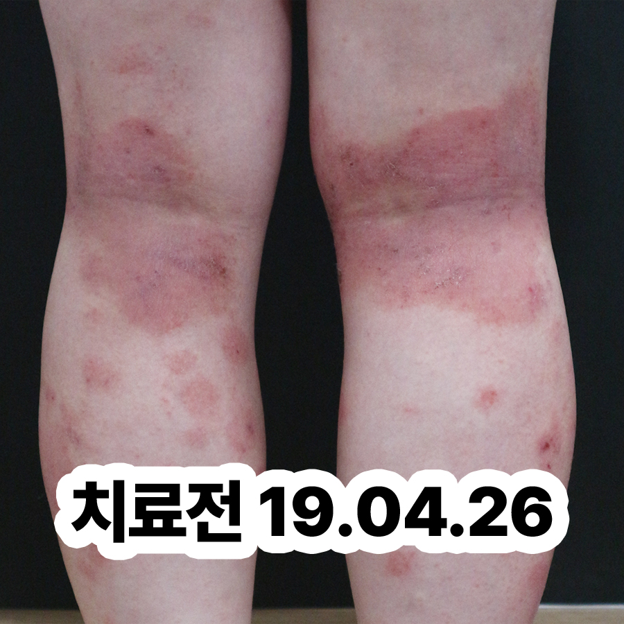 분당 아토피 한의원 관련 이미지 2
