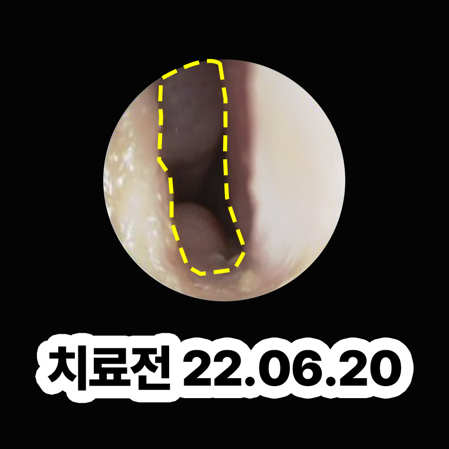 분당 축농증치료방법 관련 이미지 2